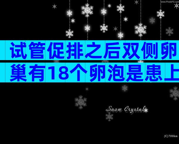 试管促排之后双侧卵巢有18个卵泡是患上了多囊综合症吗？
